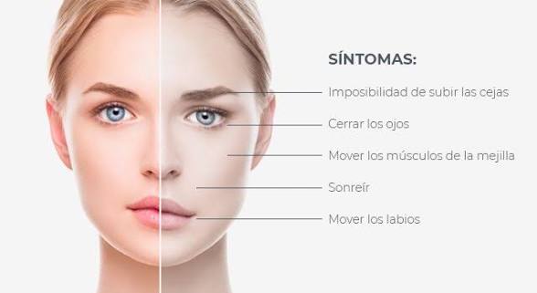 Parálisis facial en clínica JMS